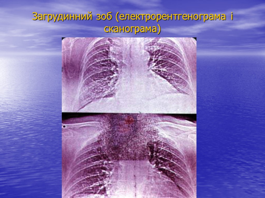 Загрудинний зоб (електрорентгенограма і сканограма)